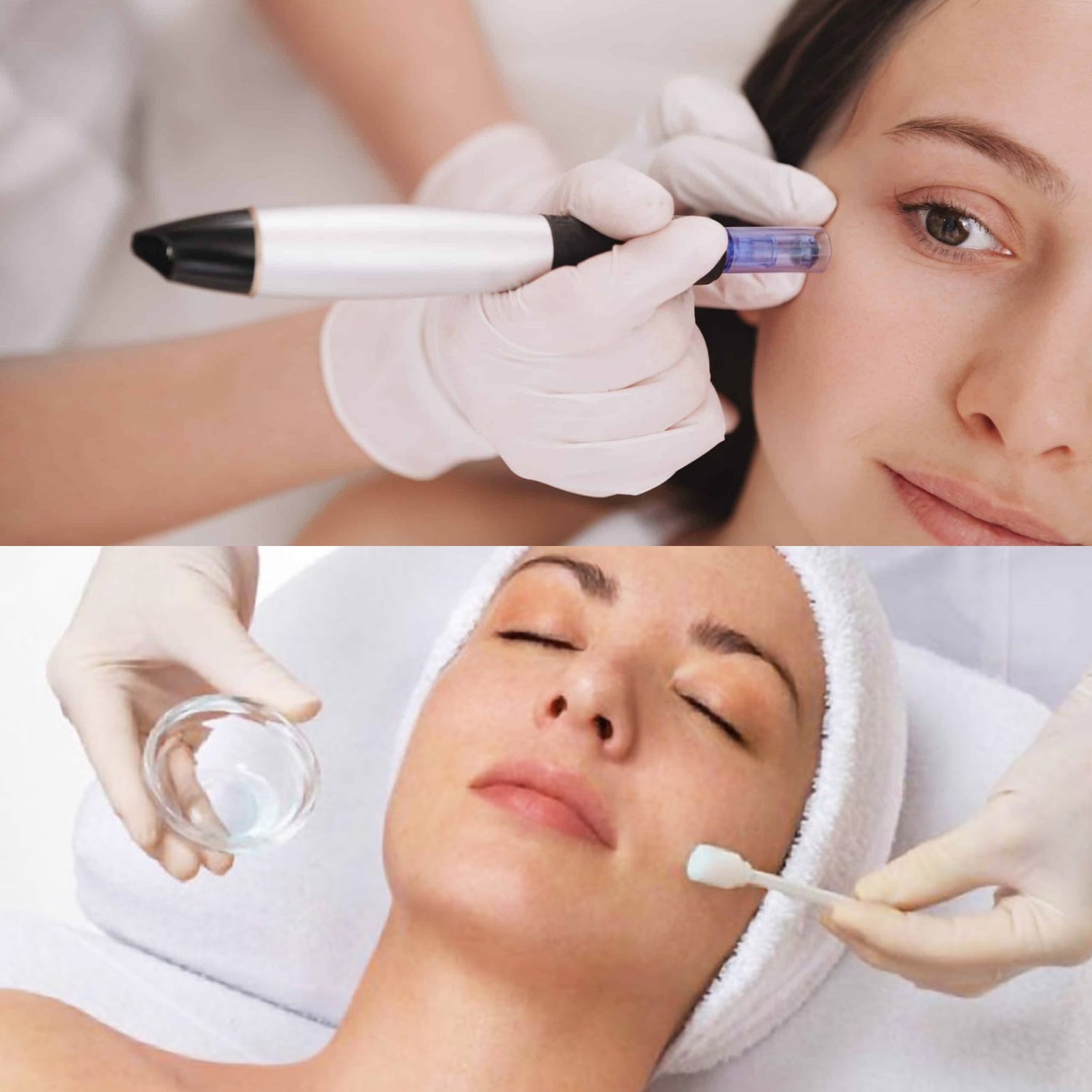 Microneedling+Peeling