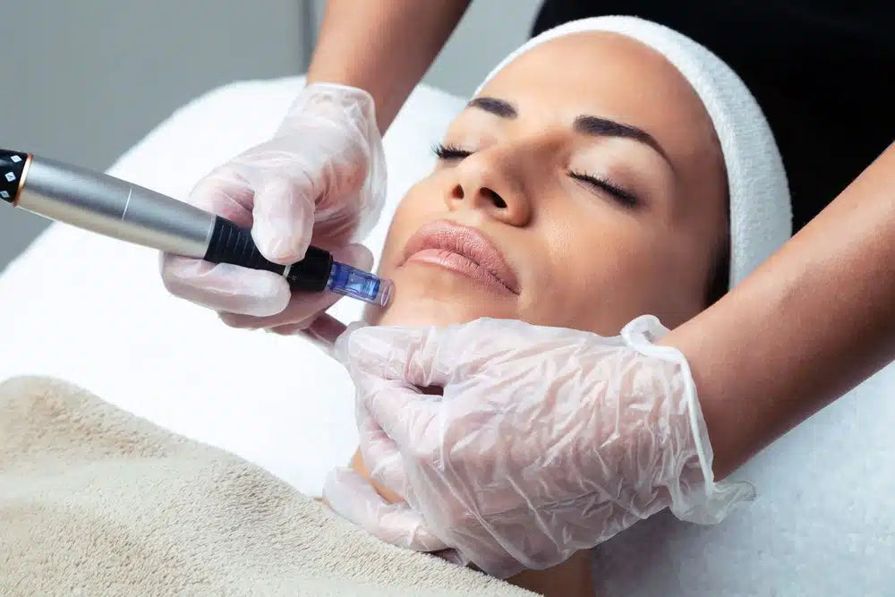 Micro-Needling avec votre propre plasma (PRP)